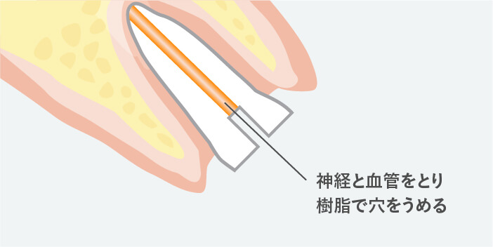 失活歯（神経の死んだ歯）