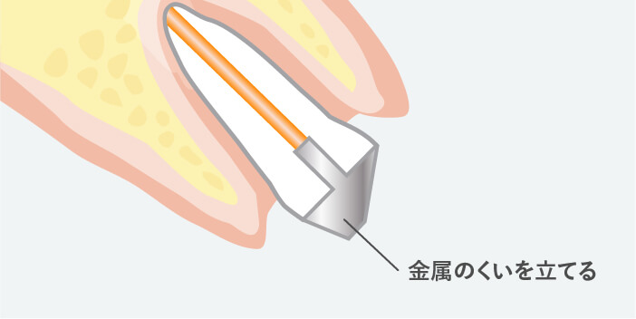 差し歯の土台作成