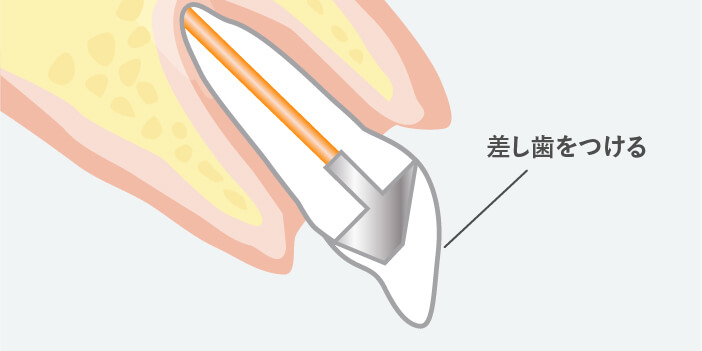 差し歯の作成