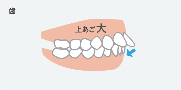 上の前歯が出ている方