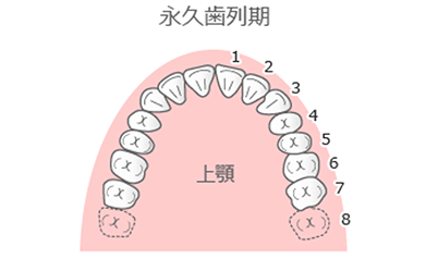 Ⅱ期治療